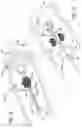 Fig. 08 - Pulmonary Embolism Removal System