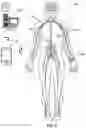 Fig. 02 - Optimized intrathecal drug delivery