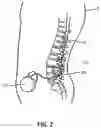 Fig. 03 - Optimized intrathecal drug delivery