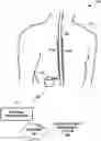 Fig. 01 - Sensing cardiac signals with leads implanted in epidural space