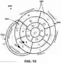Fig. 16 - VfA cardiac resynchronization therapy