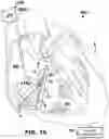 Fig. 17 - VfA cardiac resynchronization therapy
