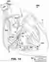 Fig. 19 - VfA cardiac resynchronization therapy