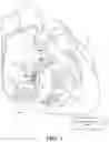 Fig. 02 - Capture in ventricle-from-atrium cardiac therapy