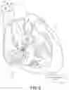 Fig. 03 - Capture in ventricle-from-atrium cardiac therapy