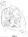 Fig. 04 - Capture in ventricle-from-atrium cardiac therapy