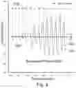 Fig. 04 - Magnetic Stimulation With Random Variable Pulsed Intervals