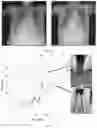 Fig. 32 - COMPOSITIONS AND METHODS FOR THE DIAGNOSIS AND TREATMENT OF LYMPHATIC SYSTEM DISORDERS