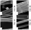 Fig. 06 - SYSTEMS HAVING POLYMERIC FIBERS WITH METALLIC NANOPARTICLES THEREON AND METHODS OF FABRICATION