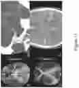 Fig. 12 - Identifying vessel occlusions using spatial patterns