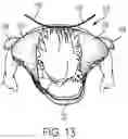 Fig. 14 - Child carrying system with adaptable head support