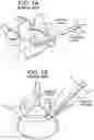 Fig. 02 - PROXIMAL-END SECUREMENT OF A MINIMALLY INVASIVE WORKING CHANNEL