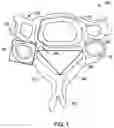 Fig. 02 - Cervical retractor and method