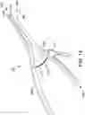 Fig. 12 - Surgical system and methods for stabilization and fixation of fractures, joints, and reconstructions