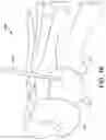 Fig. 16 - Surgical system and methods for stabilization and fixation of fractures, joints, and reconstructions