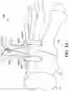 Fig. 17 - Surgical system and methods for stabilization and fixation of fractures, joints, and reconstructions
