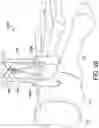 Fig. 18 - Surgical system and methods for stabilization and fixation of fractures, joints, and reconstructions