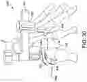 Fig. 28 - Surgical system and methods for stabilization and fixation of fractures, joints, and reconstructions