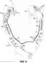 Fig. 06 - Self-retaining retractor