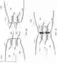 Fig. 11 - SYSTEMS AND METHODS FOR FIXING SOFT TISSUE