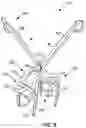 Fig. 13 - Orthopedic staple insertion