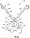 Fig. 14 - Orthopedic staple insertion