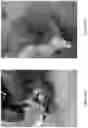 Fig. 22 - Accelerated patency magnamosis