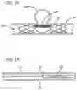 Fig. 11 - METHODS AND DEVICES FOR TREATMENT OF VASCULAR DEFECTS
