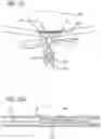 Fig. 13 - METHODS AND DEVICES FOR TREATMENT OF VASCULAR DEFECTS