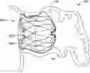 Fig. 01 - LEFT ATRIAL APPENDAGE CLOSURE IMPLANT
