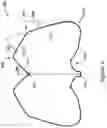 Fig. 11 - LEFT ATRIAL APPENDAGE CLOSURE IMPLANT