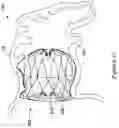 Fig. 18 - LEFT ATRIAL APPENDAGE CLOSURE IMPLANT