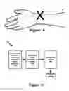Fig. 03 - Balloon assembly for use in a hemostasis band