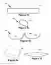 Fig. 09 - Balloon assembly for use in a hemostasis band