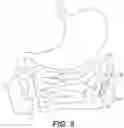 Fig. 05 - Tissue deflecting devices and related methods of use