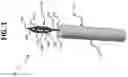 Fig. 02 - Micro-invasive surgical device and methods of use