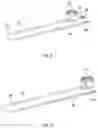 Fig. 06 - Band clamp implants