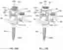 Fig. 12 - Band clamp implants