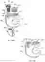 Fig. 28 - Band clamp implants