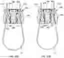 Fig. 36 - Band clamp implants