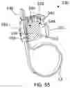 Fig. 41 - Band clamp implants
