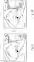 Fig. 08 - SYSTEMS AND METHODS FOR FACILITATING INSERTION OF A SURGICAL INSTRUMENT INTO A SURGICAL SPACE