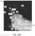 Fig. 48 - Augmented reality in arthroplasty surgery