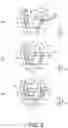 Fig. 03 - Orthodontic bracket