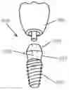 Fig. 01 - INTEGRAL-TYPE IMPLANT