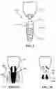 Fig. 03 - INTEGRAL-TYPE IMPLANT