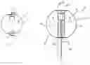 Fig. 03 - INTRAVESICULAR DEVICE FOR CONTROLLING URINARY INCONTINENCE