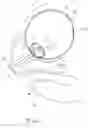 Fig. 04 - INTRAVESICULAR DEVICE FOR CONTROLLING URINARY INCONTINENCE