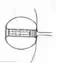Fig. 08 - INTRAVESICULAR DEVICE FOR CONTROLLING URINARY INCONTINENCE