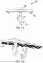 Fig. 02 - Systems and methods for mesh augmentation and prevention of incisional hernia